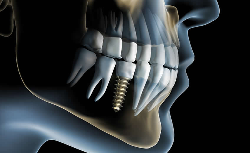 Implantologia dentale provincia di Brescia